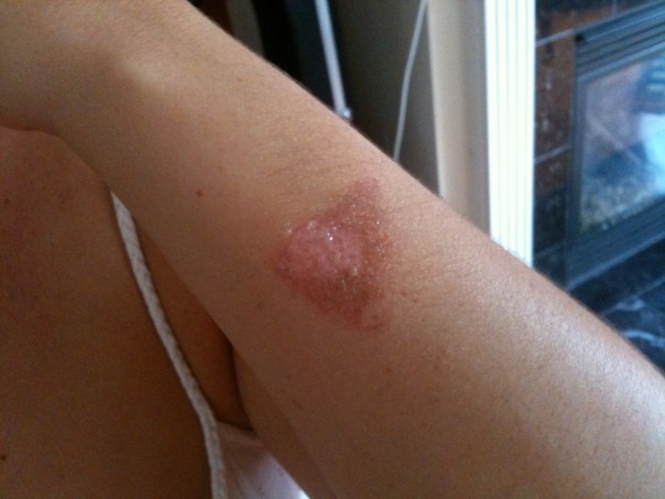 9:39 a.m. - Xan burned her arm yesterday reaching into the oven.  Ew.